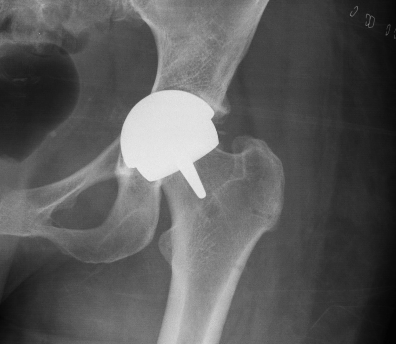 BHR Acetabular Component Protrusio